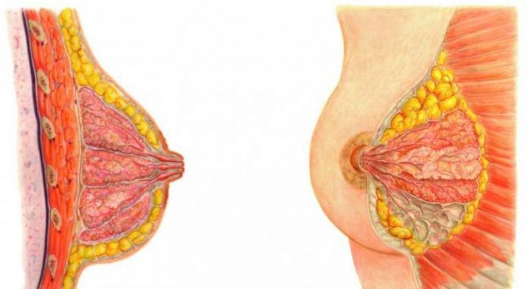13 причин внутрішньопротокова папіломи молочної залози — як проходить видалення?