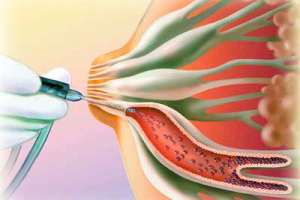 13 причин внутрішньопротокова папіломи молочної залози — як проходить видалення?