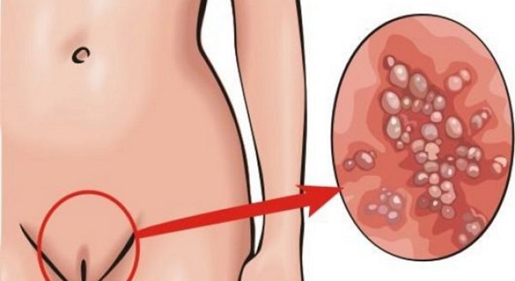 3 етапи зараження вірусом папіломи людини 18 типу