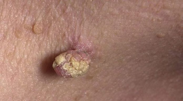 3 етапи зараження вірусом папіломи людини 18 типу