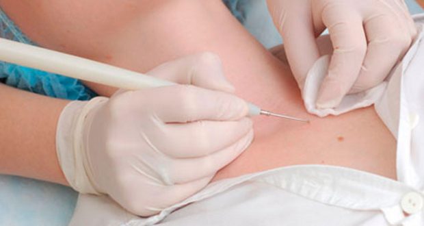 3 етапи зараження вірусом папіломи людини 18 типу