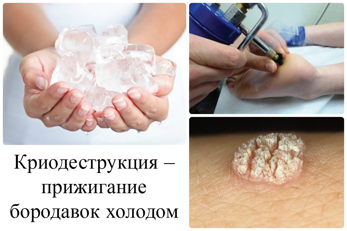 3 етапи зараження вірусом папіломи людини 18 типу