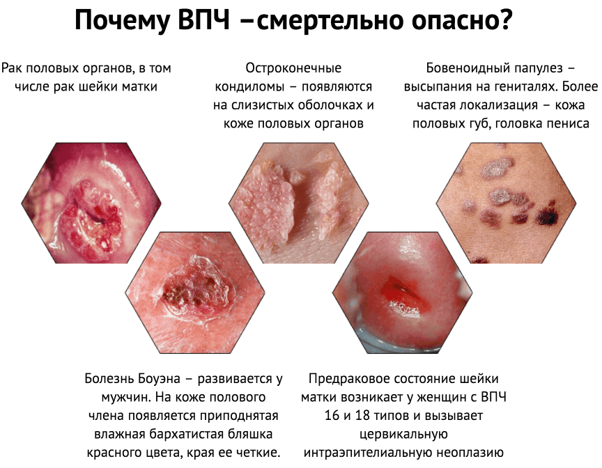 3 групи ВПЛ, у тому числі з високим онкогенних ризиком