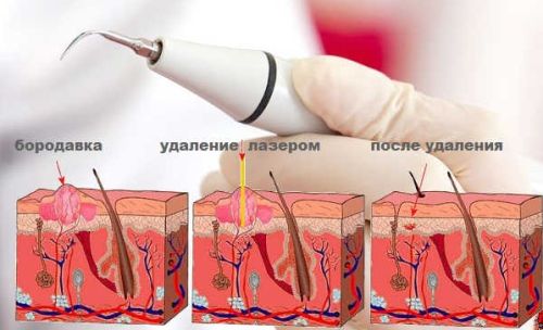 3 причини бородавок в районі рук і як їх прибрати?