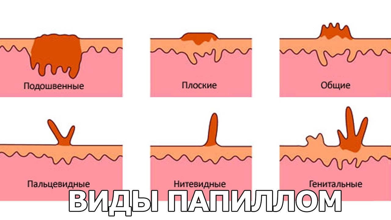 4 групи папілом у відповідності з їх розміром, а також види