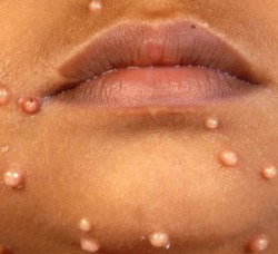 4 методу лікування (видалення) контагіозного молюска у дітей.