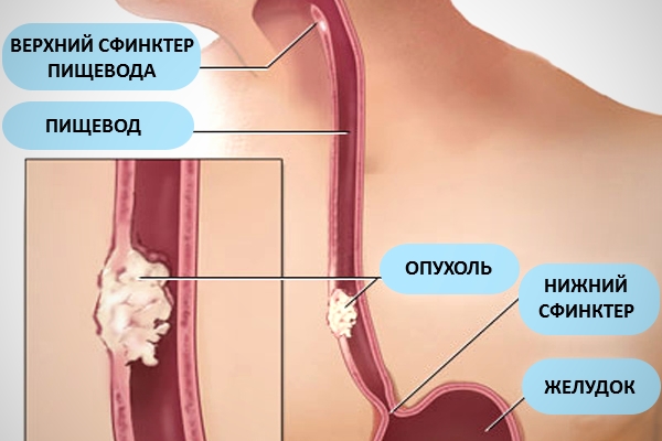 4 ускладнення плоскоклітинну папіломи стравоходу + як лікувати?
