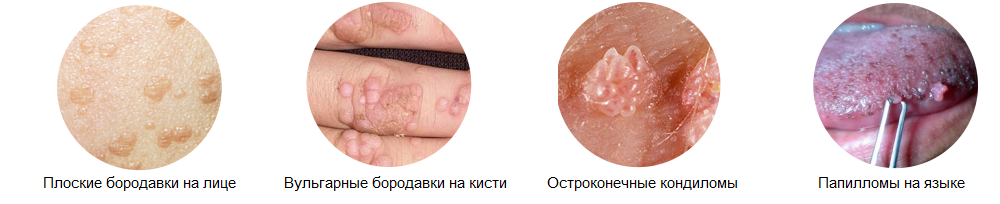 5 методів лікування і видалення папілом на обличчі, які наслідки?