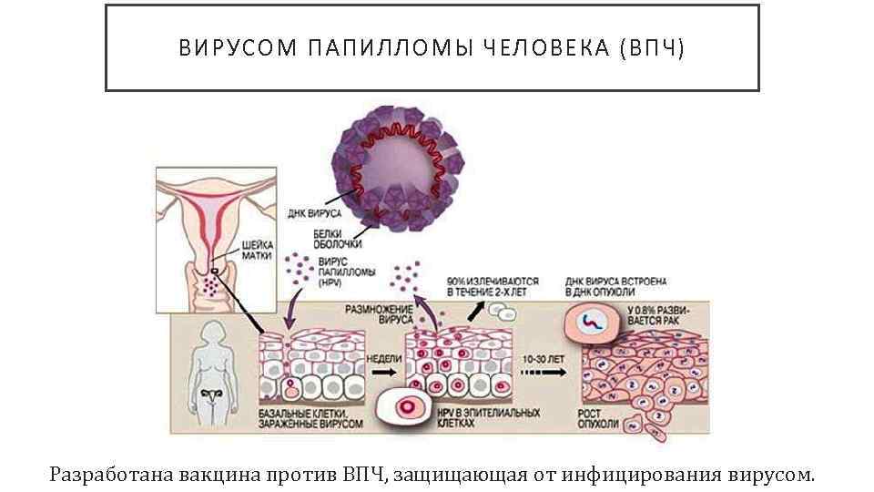 5 методів лікування ВПЛ 51 генотипу, особливо у жінок і чоловіків