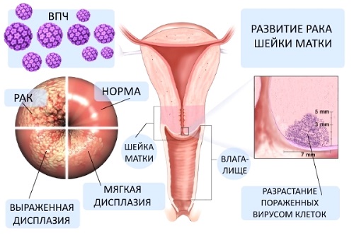 5 методів лікування ВПЛ 51 генотипу, особливо у жінок і чоловіків