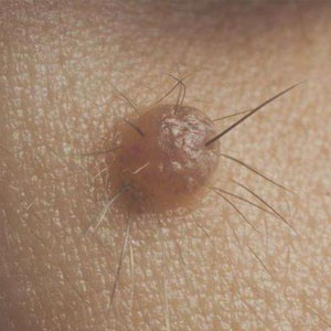 5 небезпек опуклих родимок, треба з ними боротися?