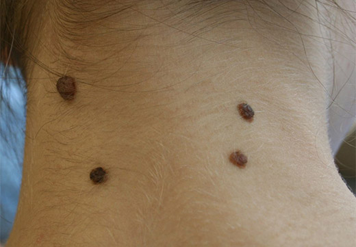5 небезпек опуклих родимок, треба з ними боротися?