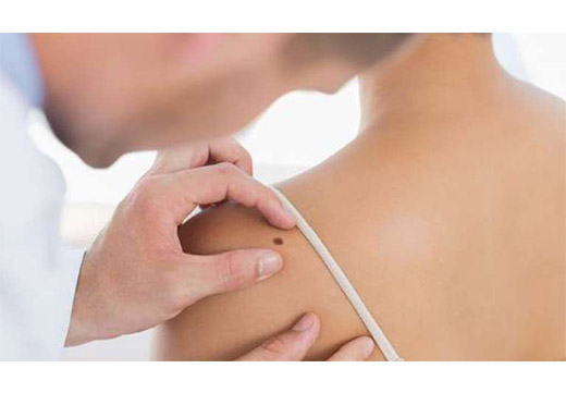 5 небезпек опуклих родимок, треба з ними боротися?