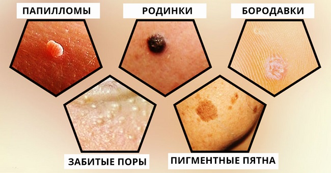5 основних відмінностей родимок від папілом з картинками