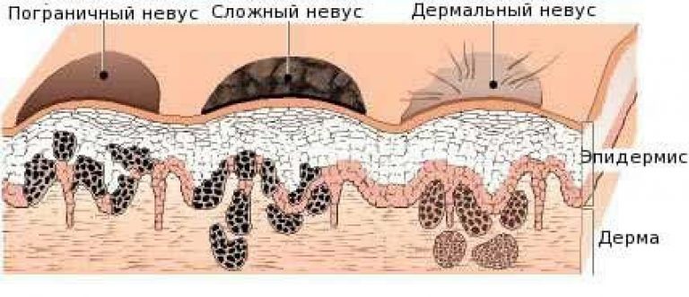 5 основних відмінностей родимок від папілом з картинками