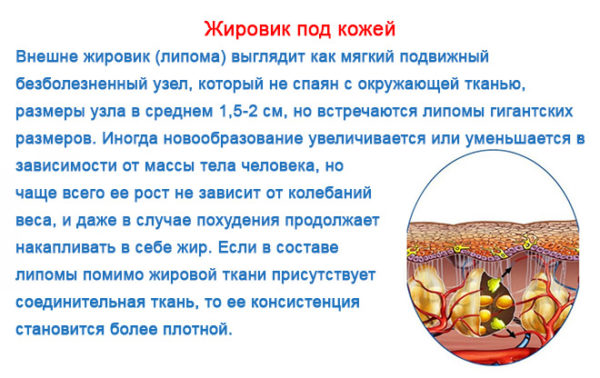 5 причин ліпоми на спині і як прибрати цей жировик?
