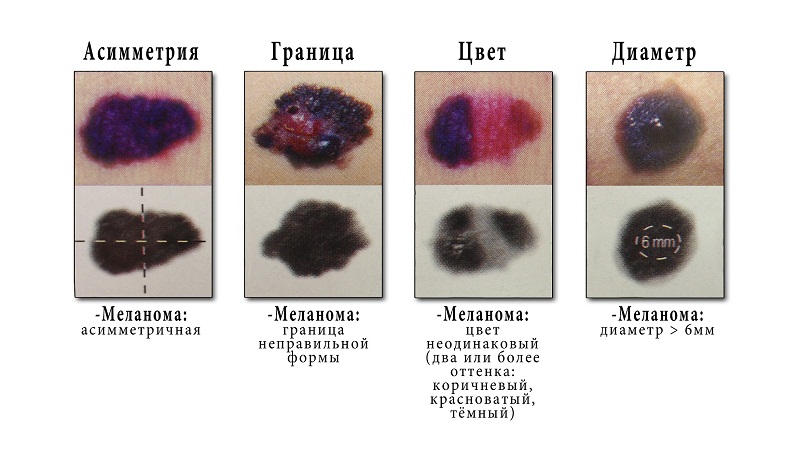 5 причин потемніння родимок, чи потрібно їх видаляти?