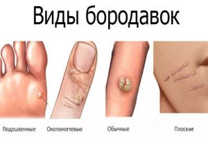 5 причин зміни кольору папілом, що робити якщо болить або засохла
