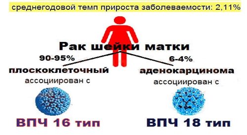 5 відмінних особливостей ВПЛ 16 типу від інших типом вірусу папіломи
