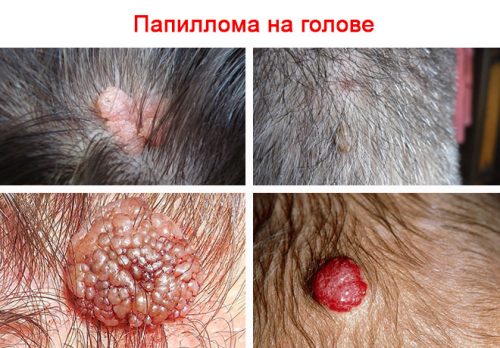 6 методів лікування папіломи на голові