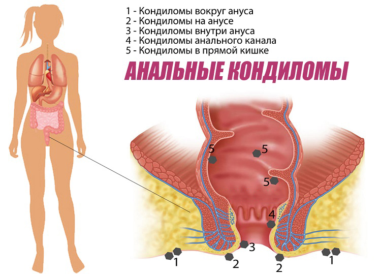 6 видів анальних кондилом, чим вони небезпечні для прямої кишки?