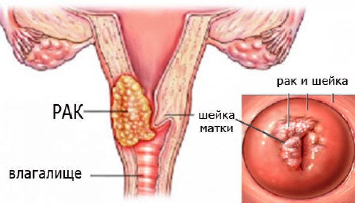 7 причин папілом в зоні геніталій — як і з допомогою чого позбутися?