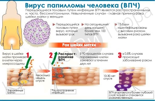 7 симптомів вірусу папіломи людини 52 типу у чоловіків і жінок