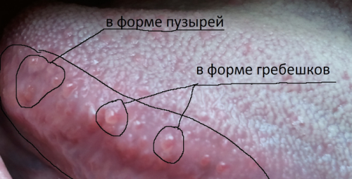 8 причин кондилом на язику і в горлі, в чому небезпека?