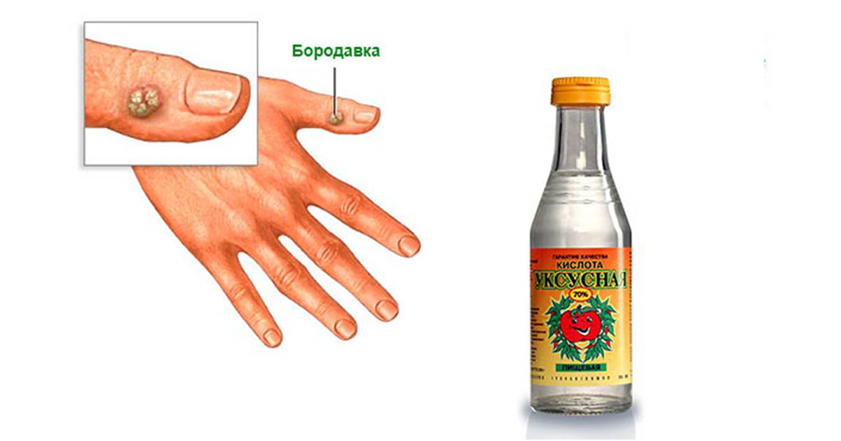 9 способів видалення (припікання) бородавки в домашніх умовах