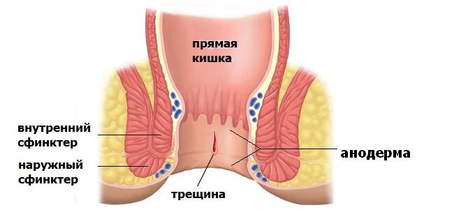 Анальні тріщини – причини і лікування в домашніх умовах