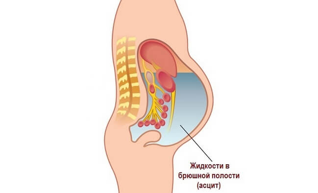 Асцит при цирозі печінки: що це і як лікувати?