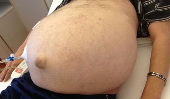 Асцит при цирозі печінки: що це і як лікувати?