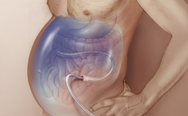Асцит при цирозі печінки: що це і як лікувати?