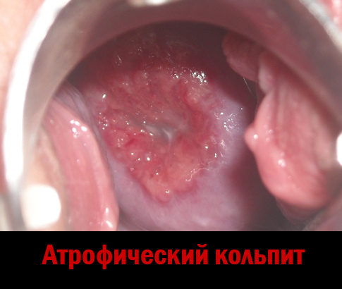 Атрофічний кольпіт у жінок менопаузального періоду, симптоми і лікування