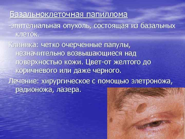 Базальноклітинна папілома — 4 етапи розвитку та форми