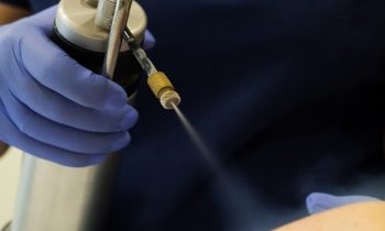 Боляче видаляти папіломи рідким азотом і які можуть бути ускладнення?