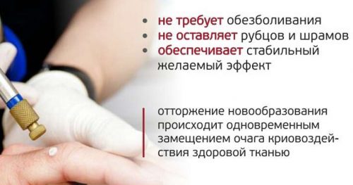 Боляче видаляти папіломи рідким азотом і які можуть бути ускладнення?