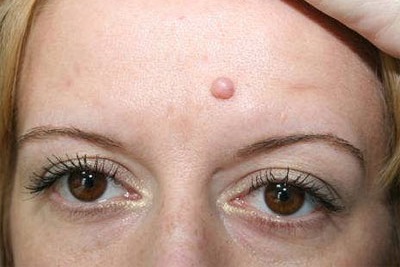 Бородавки на губах, носі, в роті — як відбувається зараження?