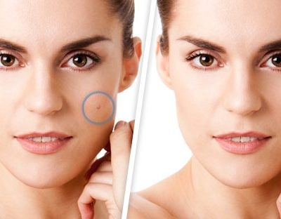 Бородавки на губах, носі, в роті — як відбувається зараження?