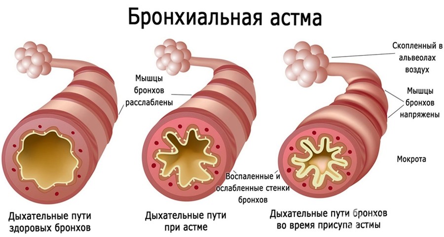 Бронхіальна астма: симптоми, види та лікування у дорослих