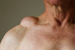 чи Можна позбутися від ліпоми в домашніх умовах? Чим лікувати?