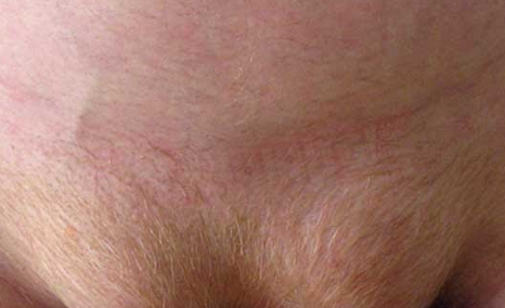 Чому на лобку сиве волосся у жінок передчасно: причини