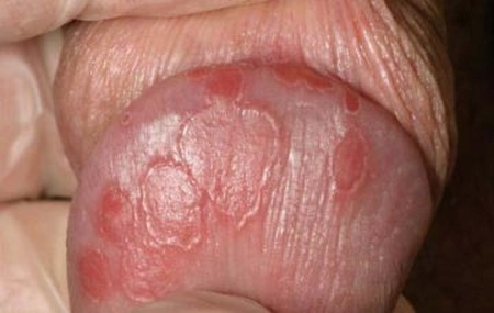 Чому від члена неприємний запах і що робити