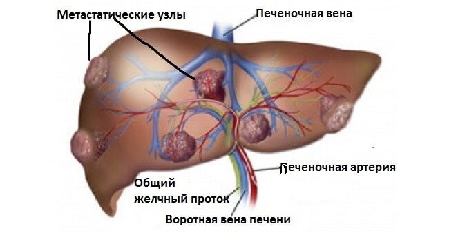 Чому з’являються метастази в печінці і як лікувати?