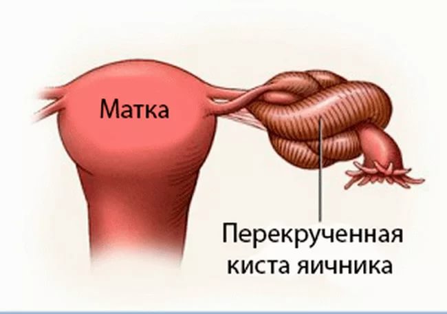 Дермоїдна кіста яєчника: причини, симптоми і лікування