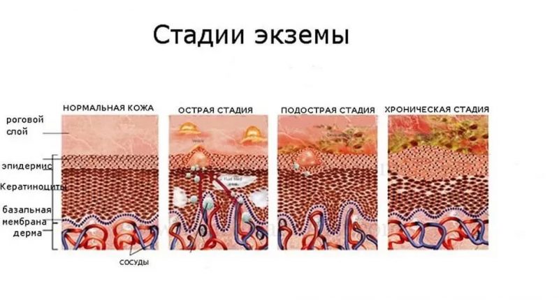 Екзема на тілі: ознаки появи шкірної патології та її лікування