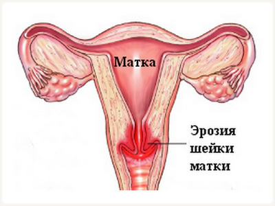 Ерозія шийки матки: фото, причини, симптоми, лікування, відгуки