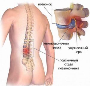 Хребетна грижа поперекового відділу. Симптоми і лікування