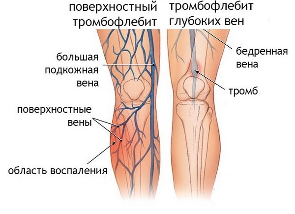 Кінський каштан від варикозу. Настоянка з каштанів від варикозу – рецепт на горілці, на спирту, мазь