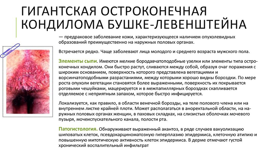 Класифікація кондилом — чим небезпечний кожний вид?